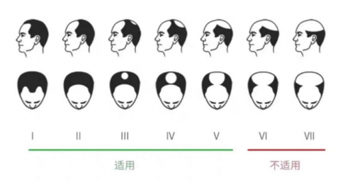 小米眾籌銷量驚人的可思美激光生發(fā)帽，真的能生發(fā)嗎？