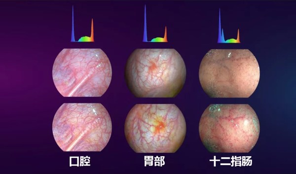 光隨影動(dòng) 開立醫(yī)療國產(chǎn)內(nèi)鏡功能領(lǐng)跑智能新方向